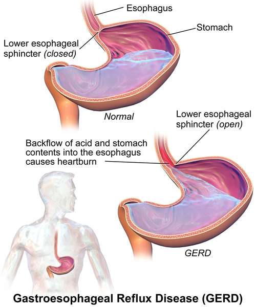 Labeled diagram of GERD, showing stomach with backflow of acid and stomach contents into esophagus