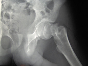 An x-ray of a fractured hip