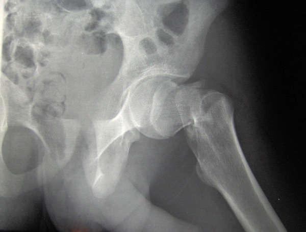 Black-and-white X-ray photo of human hip, showing a broken femur